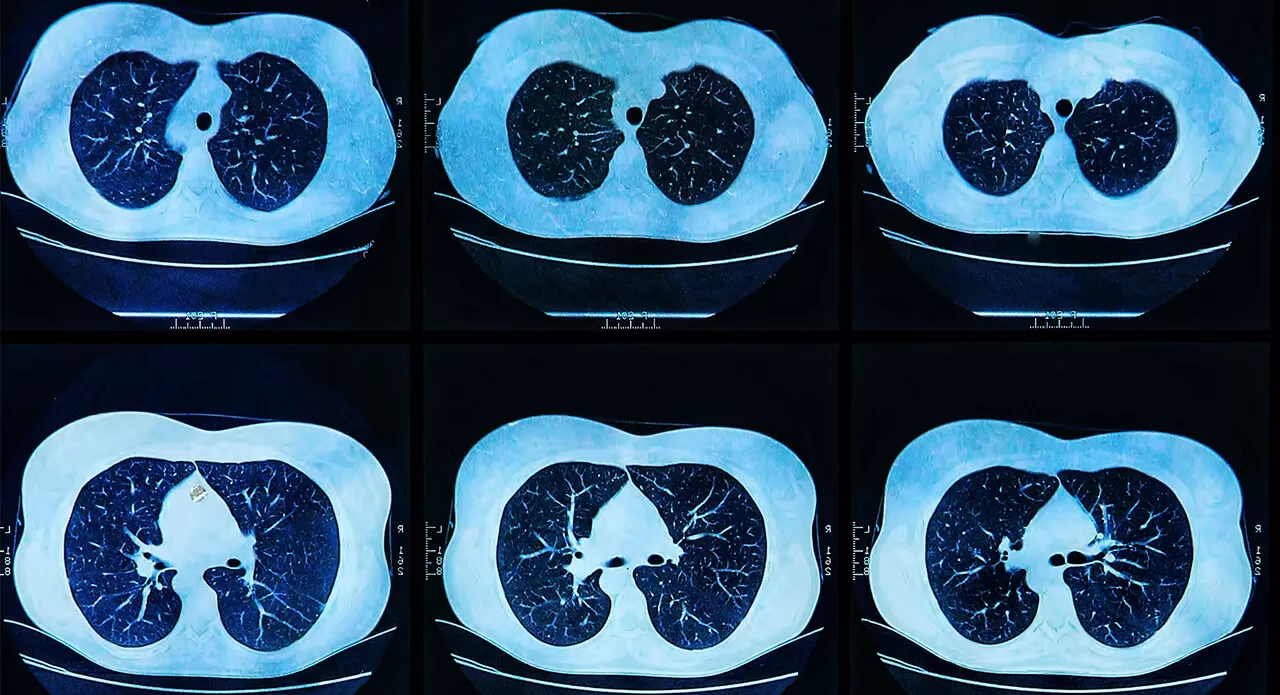 mri_scan_of_the_human_lungs1280x695.jpg